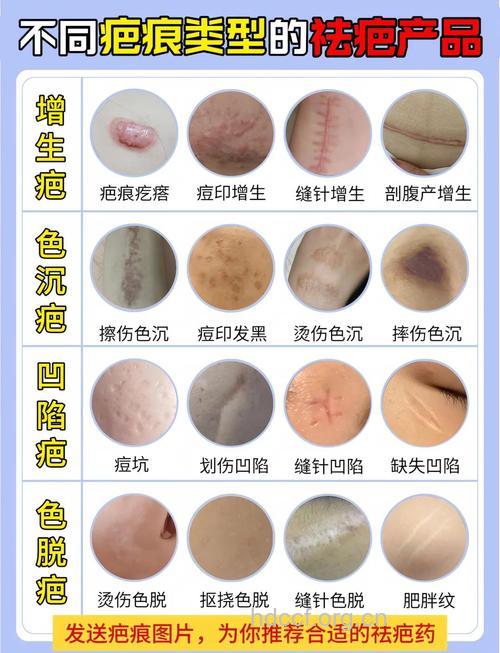 7种手术去痘印疤痕的方法