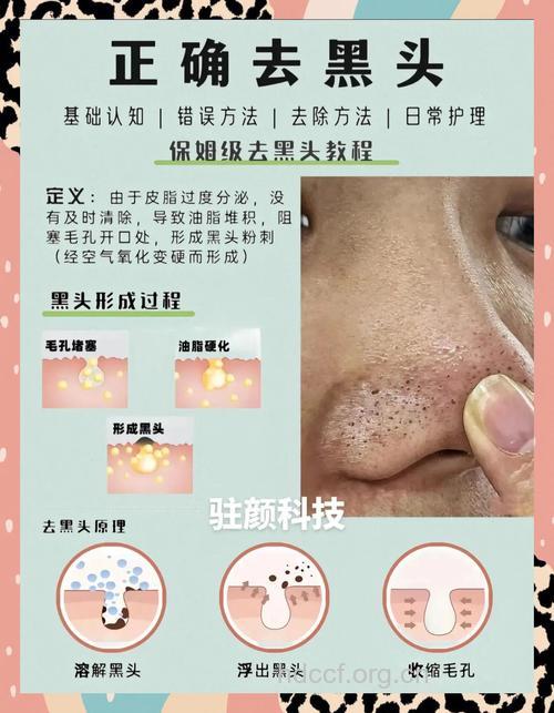 经常做去角质为什么还一直在长黑头粉刺