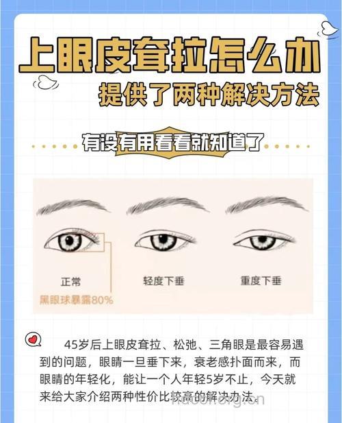 上眼皮松弛了怎么办呢