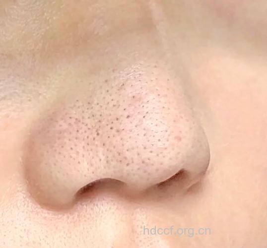 牢记这四招 草莓鼻将不再光顾你