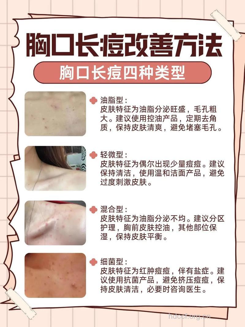 为什么胸前会长痘痘 如何祛除