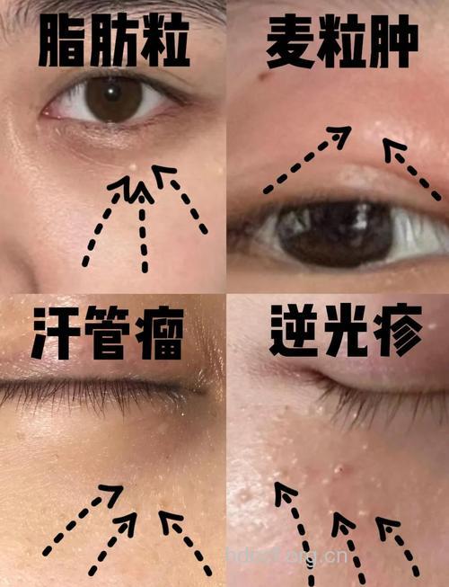 盘点网上爆料的脂肪粒元凶