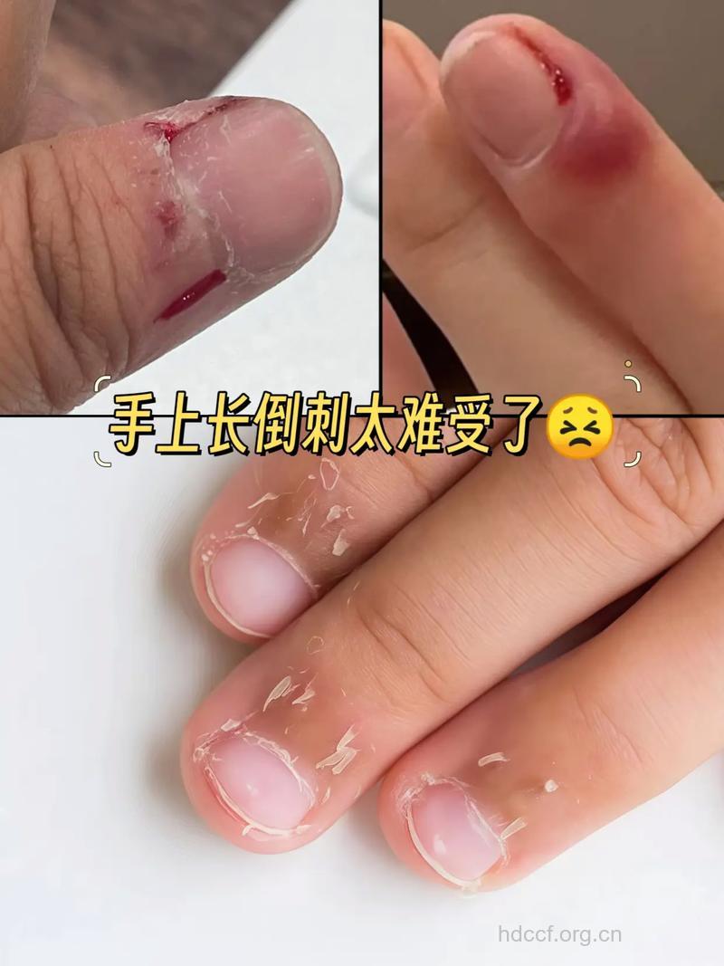 甲缝常长“倒刺”怎么办