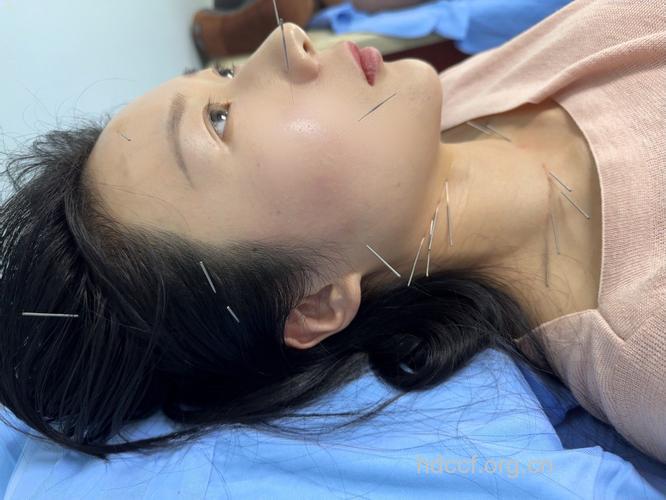 针灸美容到底痛不痛