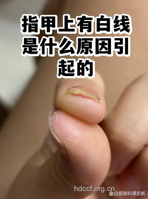 指甲上出现白线的原因