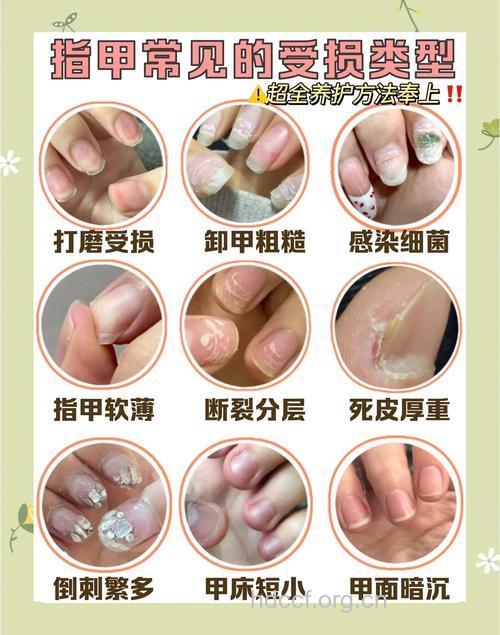 指甲问题全攻略 断甲肉刺