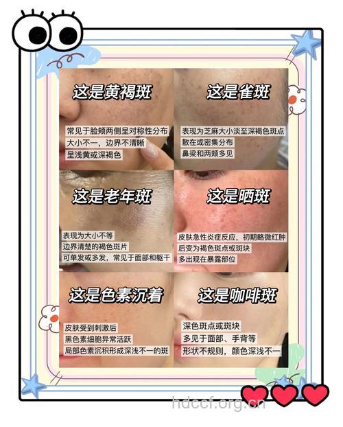 认清斑的类型 轻松巧去除