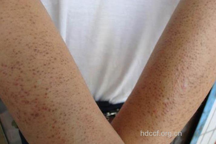 缺乏维生素A皮肤会怎样