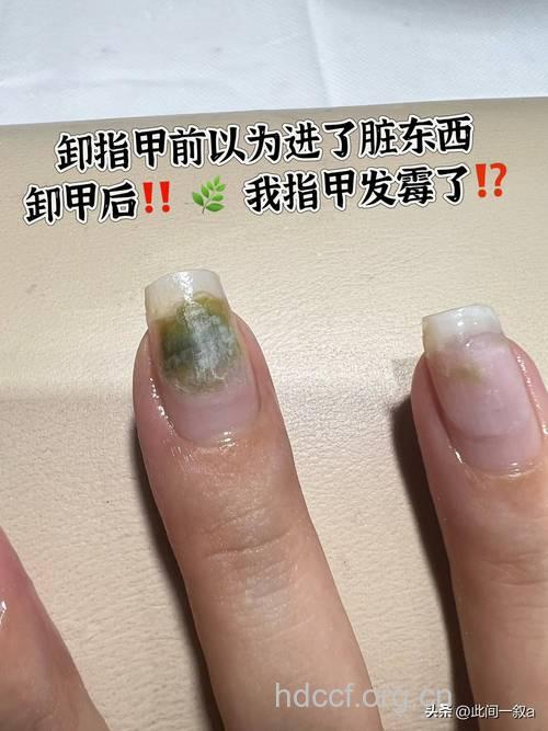 美甲会导致各种感染病