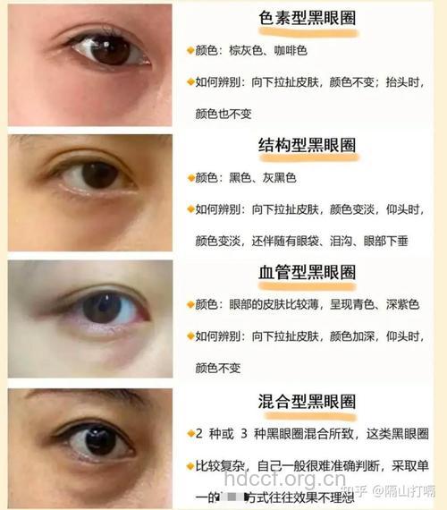 眼霜能治鱼尾纹、眼袋和黑眼圈吗