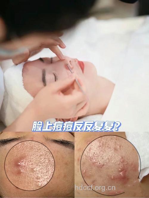 DIY天然祛痘印 还肌肤光滑水嫩