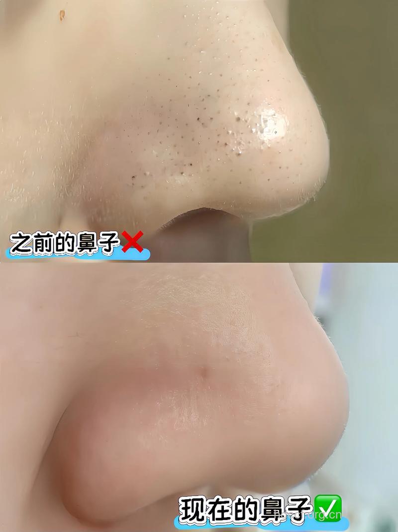 与黑头抗战到底 拒绝草莓鼻