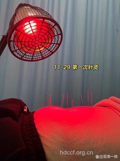 林叶亭:针灸减肥瘦16斤