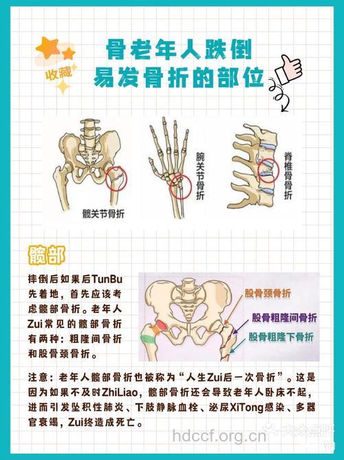 老人跌倒后哪些部位最容易出现骨折