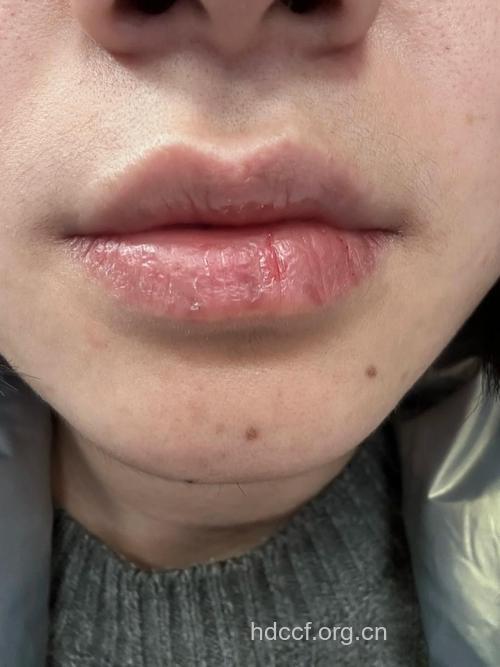 纱布去鼻翼嘴唇脱皮