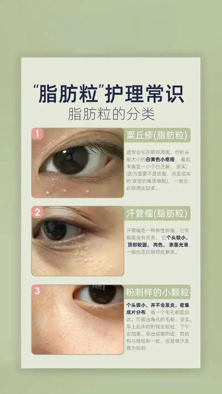 如何祛除眼部脂肪粒