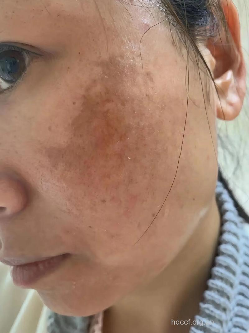 神奇！脸上的斑一吃就掉