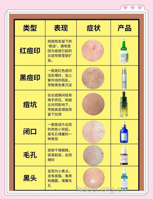 轻松祛痘印的五个小窍门