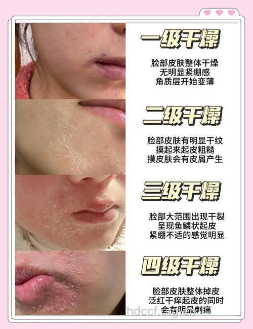 皮肤干燥脱皮怎么办