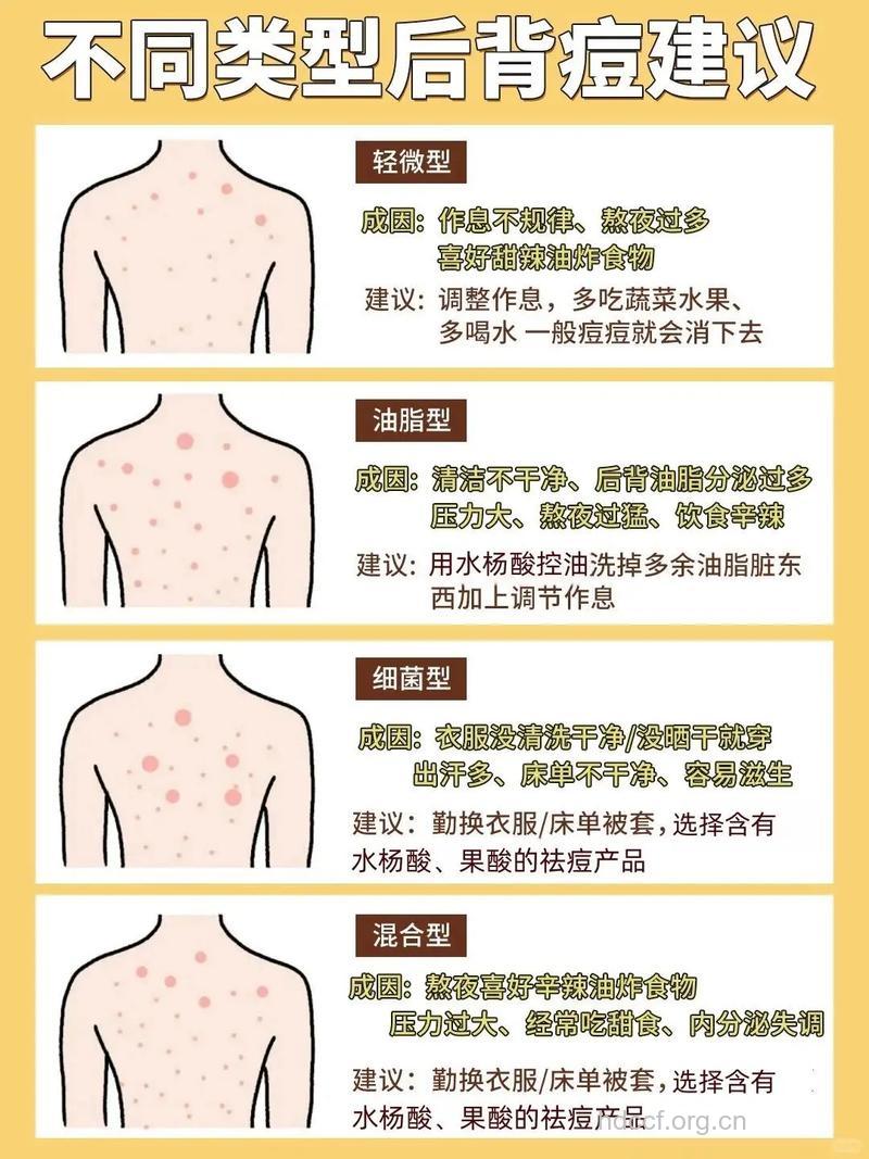 哪些生活细节可远离背部痘痘
