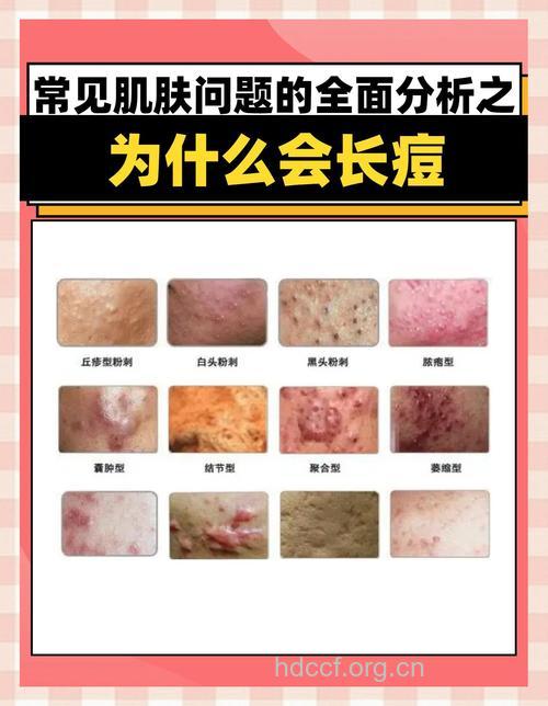 关于痘痘的真凶是什么