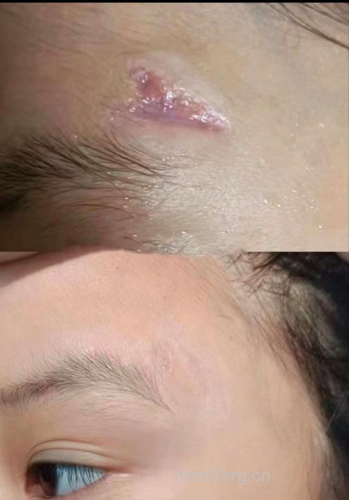 祛疤美肤做好“表面功夫”