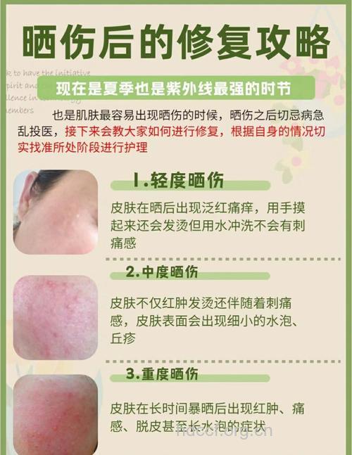 夏季护肤 皮肤暴晒后的护理技巧