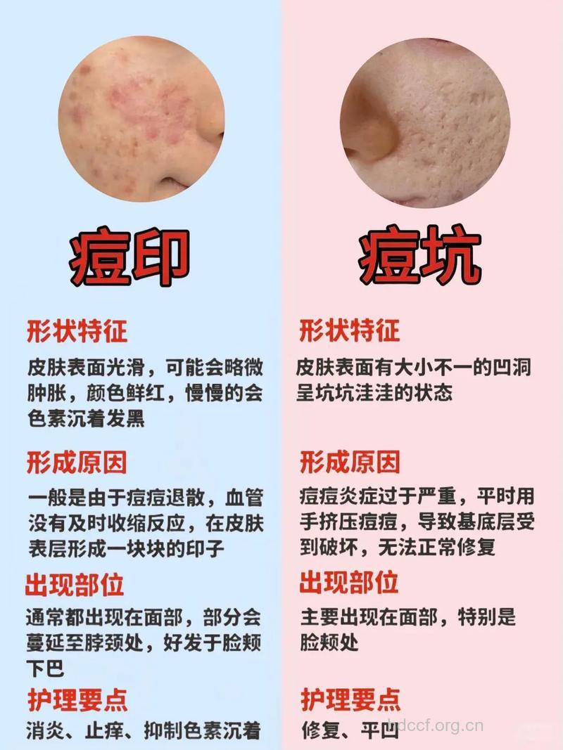 怎么对抗顽固痘印方法