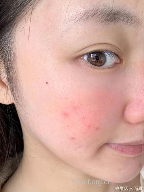 春季用厚重面霜或易长痘