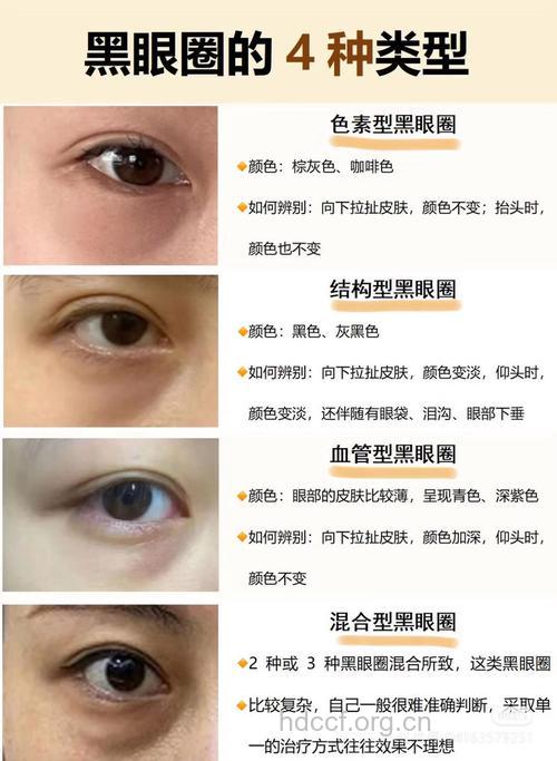 你的黑眼圈属于哪一类型?