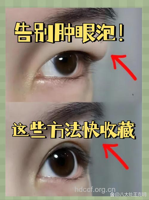 7个妙招去除水肿金鱼眼