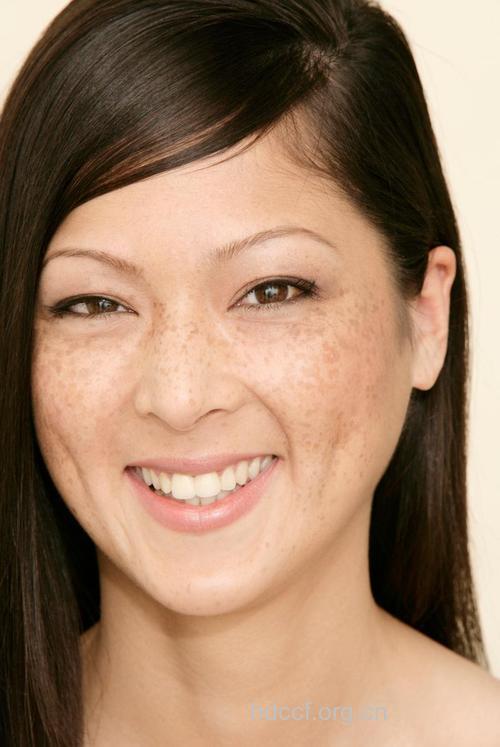 女性天生易长斑的五个时期