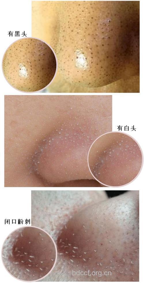 你懂的 去黑头快速有效的方法