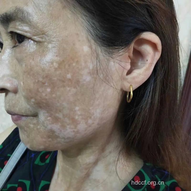 采珂祛斑霜汞超标 过分美白患肾病