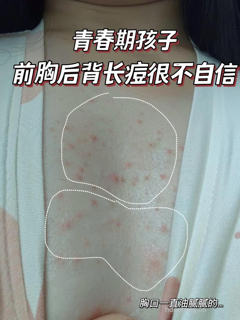 知道吗 穿着不当也会导致痘痘