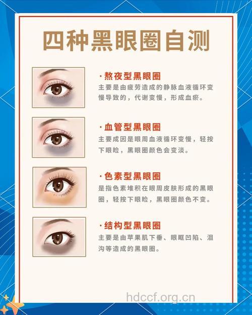 盘点黑眼圈产生的原因与分型