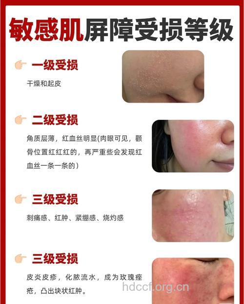春季警惕肌肤敏感情况等级
