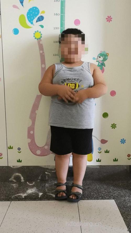 几种儿童病态性的肥胖