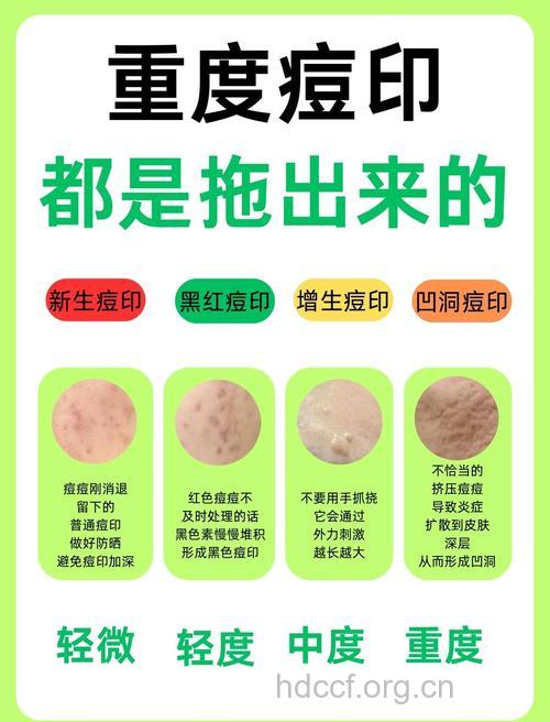 去痘6个方法 让痘印跑光光