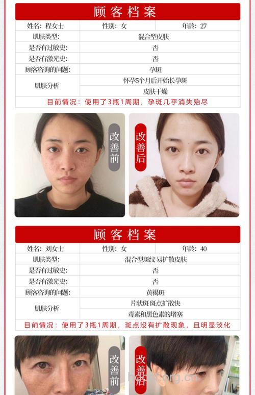 黑色素递减技术能祛除哪些色斑