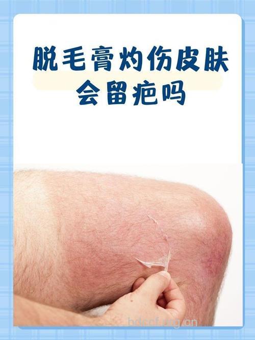 一场由脱毛引起的官司