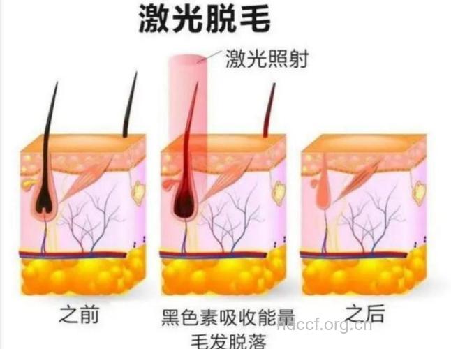 激光脱毛有哪些原理和特点