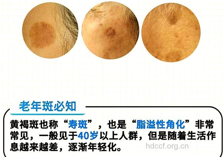 '寿斑'并不是长寿标志