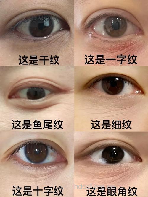 眼部会长皱纹的6大问题