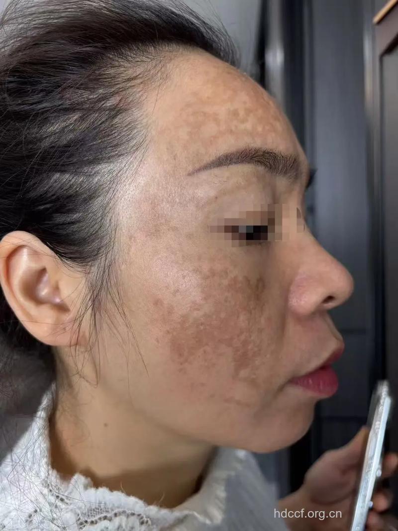 美容院祛斑成花脸