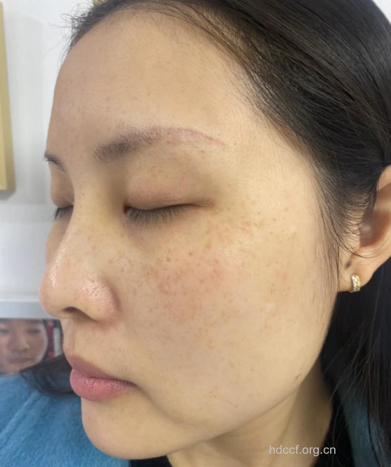 黄褐斑