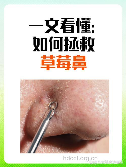 夏季如何消灭草莓鼻?