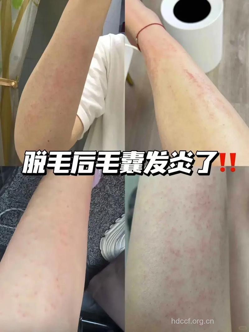 脱毛防毛的同时预防毛囊炎
