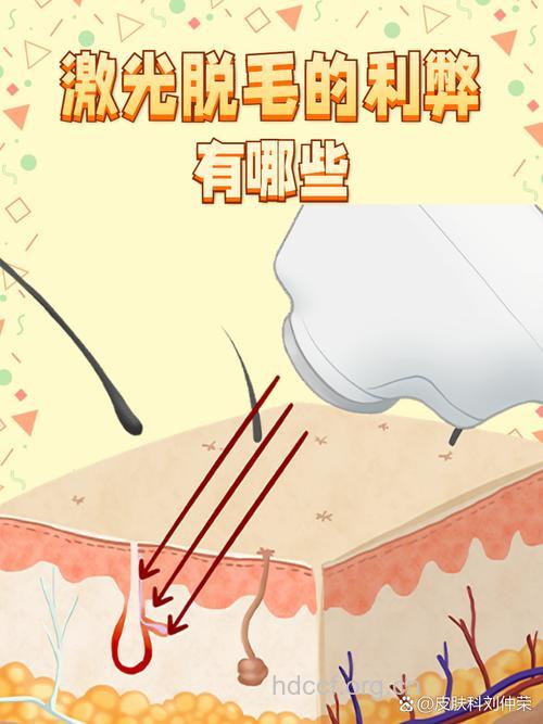 光子脱毛技术有哪些优势