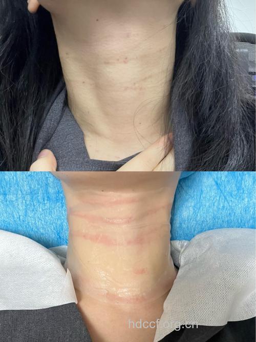 消除颈纹 让女人年轻10岁（图）